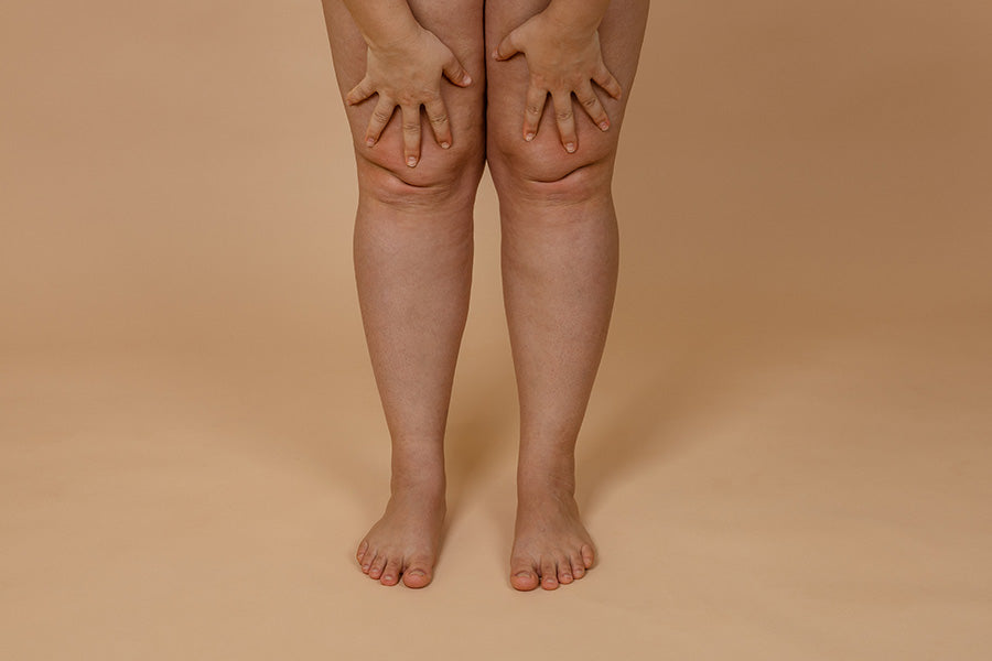 5 Best Non-Surgical Techniques to Eliminate Knee Fat, According to Experts
