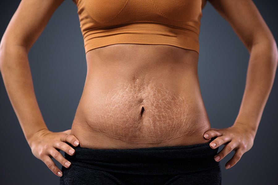 How to Get Rid of My Belly Pooch After Pregnancy?