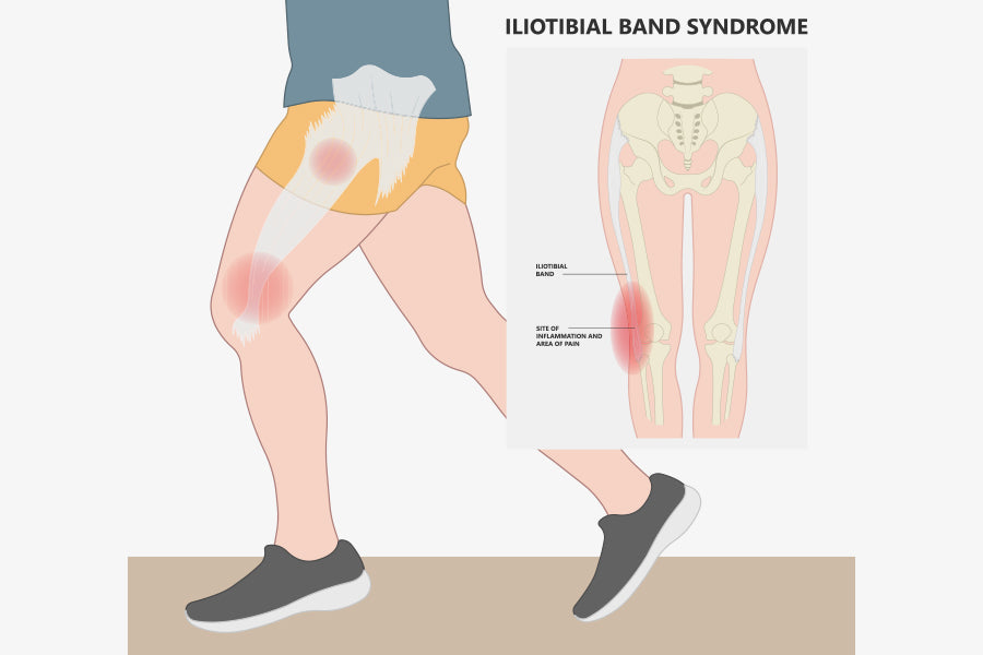 Get Rid of Snapping Hip Syndrome, Iliotibial Band Tightness
