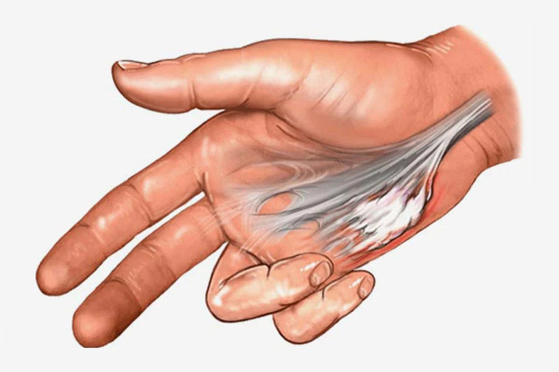 Palmar Fascia: 8 Pain Relief Tips for Dupuytren’s Contracture