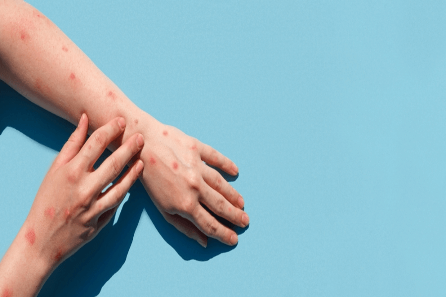 Beat the Rash: Know What Stress Does to Your Skin and How to Soothe It.