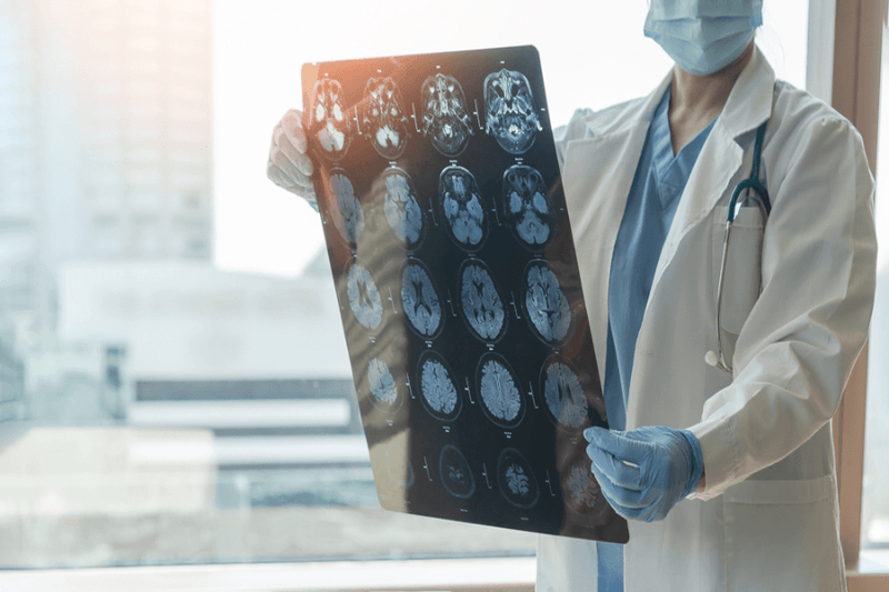 Breakthrough Discovery: High Blood Pressure Damages Brain Regions Linked to Mental Decline and Dementia!