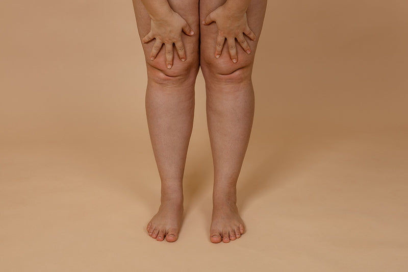 5 Best Non-Surgical Techniques to Eliminate Knee Fat, According to Experts
