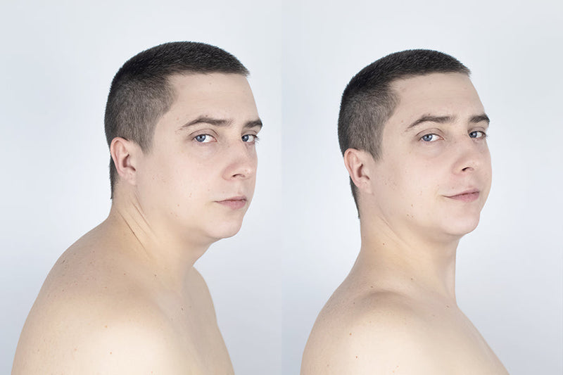 How to Get Rid of Neck Hump Fast